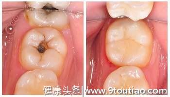 你以为蛀牙不看牙医是省钱省事？趁早补牙才是真正的省钱