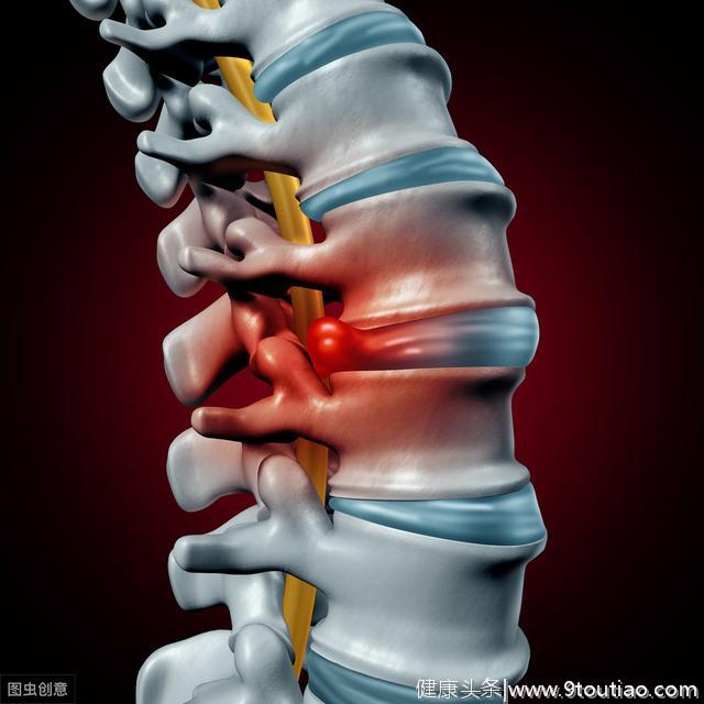 腰痛腿麻是椎间盘突出症吗？椎间盘突出有什么表现？
