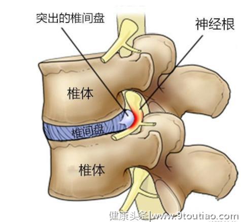 容易被误诊为腰间盘突出的11种腰部疾病，医生的医术很关键