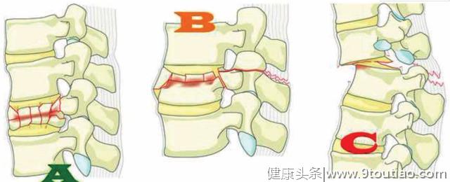 容易被误诊为腰间盘突出的11种腰部疾病，医生的医术很关键