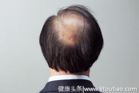 科普：现代人为什么越来越多脱发？哪些男性更容易患雄激素脱发？