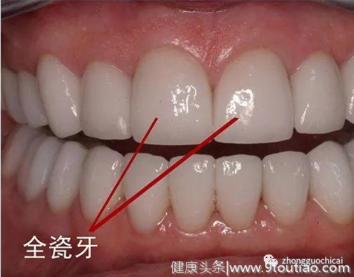 牙齿缺失之后镶个什么假牙好？有什么优势？最好的假牙是哪种？