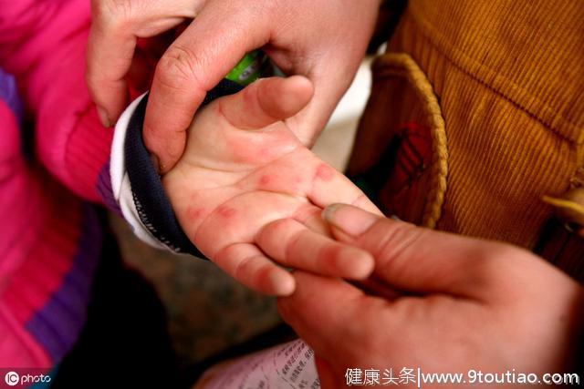又到手足口病高发期，为什么孩子接种了手足口疫苗还得手足口病？