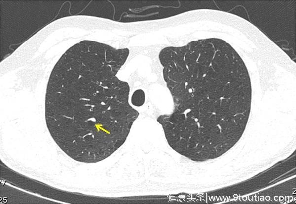 肺隔离症是什么病