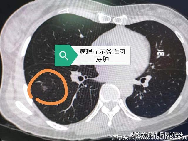 怎么分清我的增强CT片里面是肺部痰症还是肿瘤？