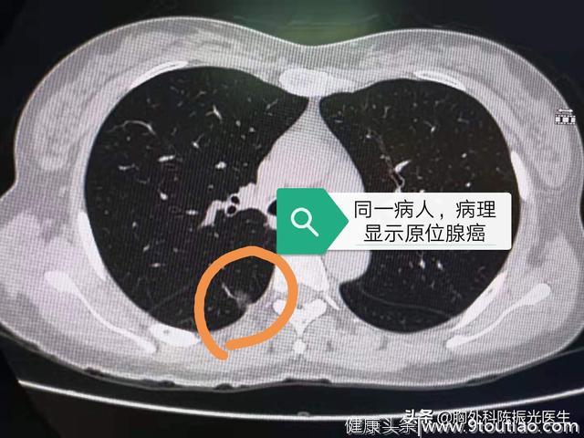 怎么分清我的增强CT片里面是肺部痰症还是肿瘤？