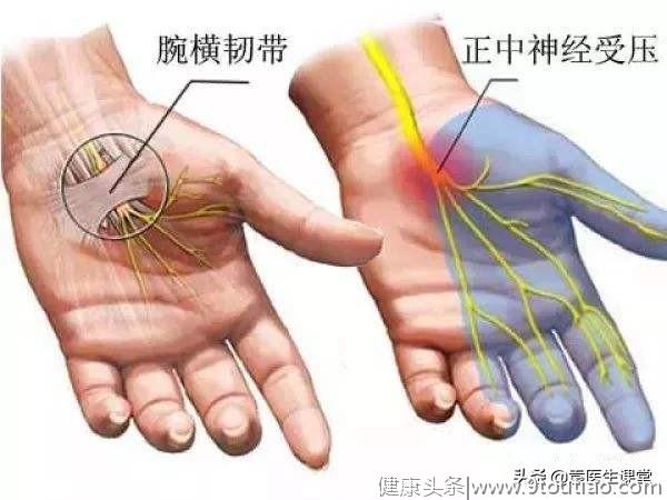 类风湿关节炎所引起的腕管综合征，会导致3个半手指麻木、疼痛