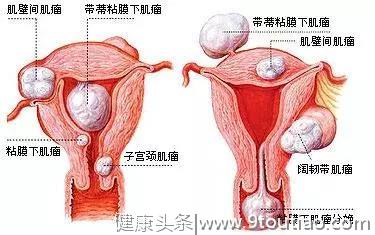 子宫肌瘤患者最想了解的八个问题