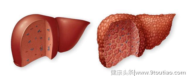 如果你符合这9点，有可能会感染上了丙肝，请查看，值得收藏