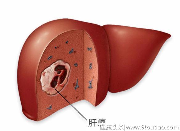 如果你符合这9点，有可能会感染上了丙肝，请查看，值得收藏