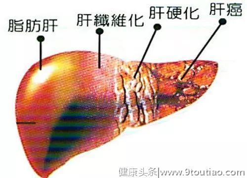 为什么吃素还能得脂肪肝？原来脂肪肝最怕的不是脂肪