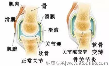 体重超标人群，患骨性关节炎概率增两倍