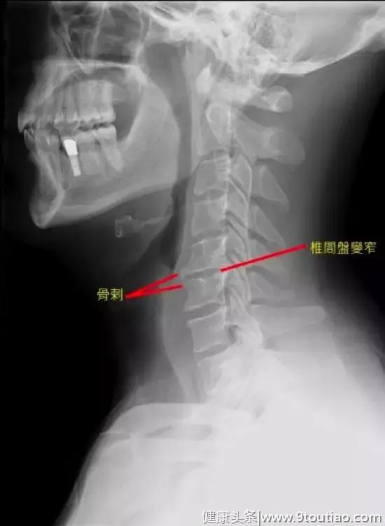 颈肩酸痛，拍个X片就能检查出颈椎病吗？