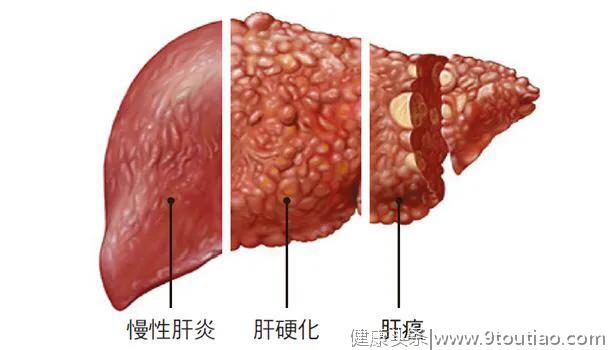 感染乙肝后，为什么有人自愈，有人转为慢性，有人成为携带者？