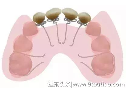 “地包天”矫正要趁早！最佳治疗时间是什么？