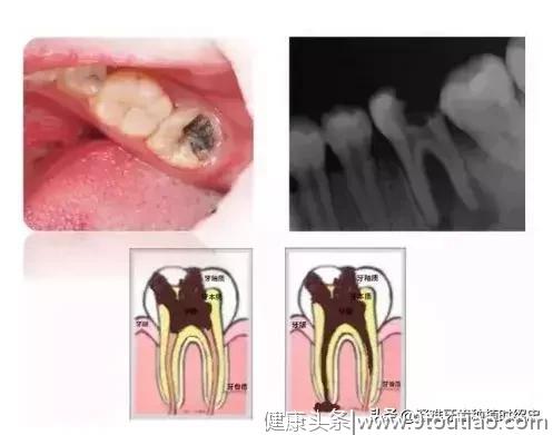 坏牙是留，还是拔？都别任性