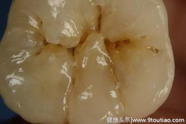 孩子患了“蛀牙”，一定要补牙吗？