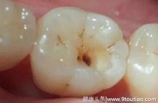 孩子患了“蛀牙”，一定要补牙吗？