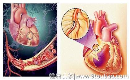 怎样知道是不是得了冠心病？