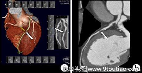 怎样知道是不是得了冠心病？