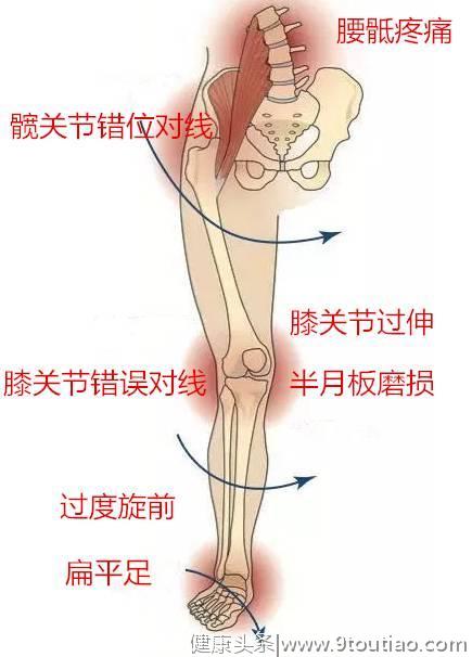 腰痛，膝盖痛，也许是你的脚出了问题