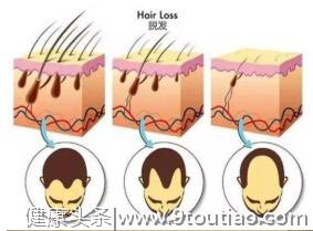 脱发是由于毛孔堵塞导致？