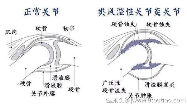 类风湿早期治疗时机：该出手时就出手!