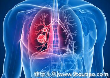 肺纤维化能治愈吗