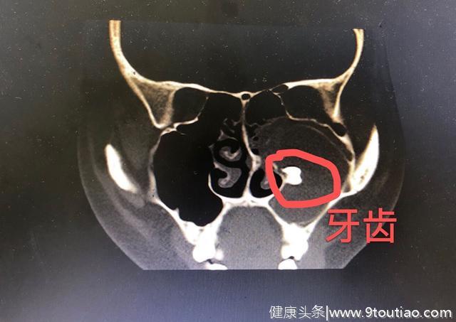 17岁女孩的鼻腔里竟长了一颗牙齿