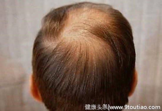 男性雄激素性脱发如何防治？怎样能延缓预防脱发？