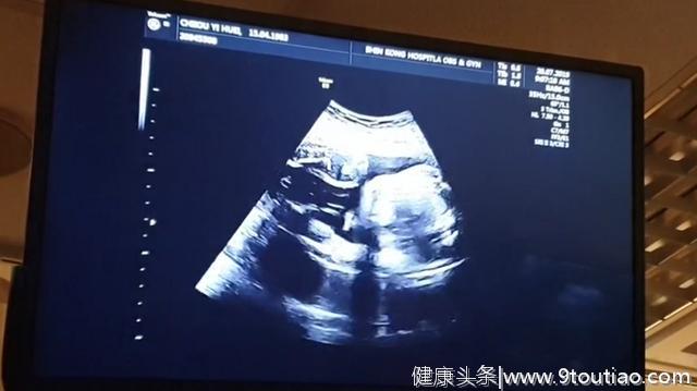怀孕8个月的孕妈做产检，被胎儿动作逗乐了，孕妈对此也很无奈