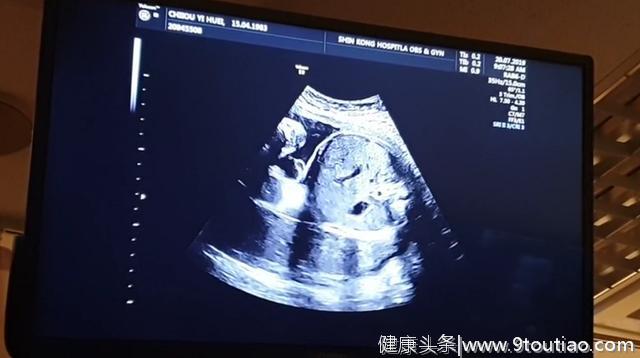 怀孕8个月的孕妈做产检，被胎儿动作逗乐了，孕妈对此也很无奈
