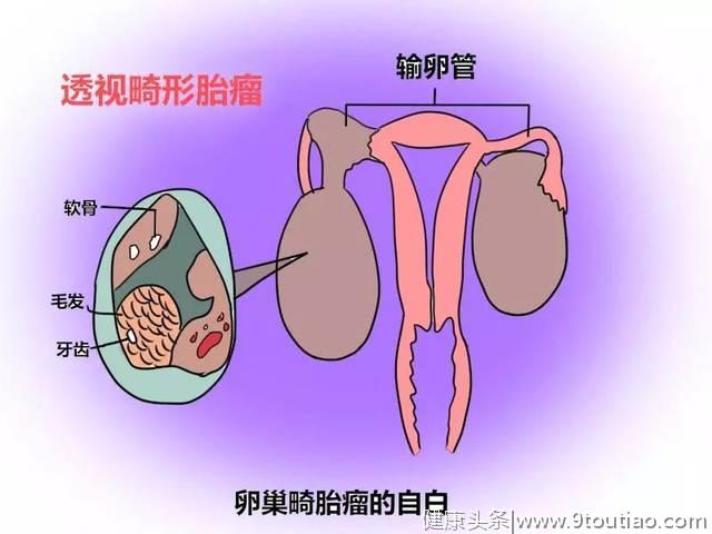 体重200斤女子，体内肿瘤藏着毛发、4颗完整的牙齿，是这病闹的