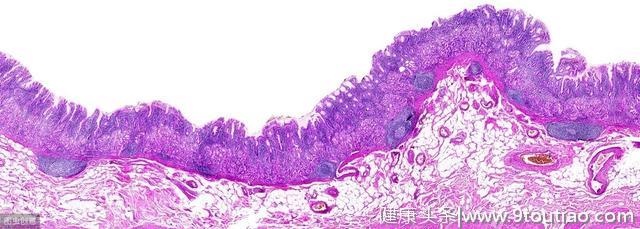 幽门螺旋杆菌如何用中医治疗？能治好么？