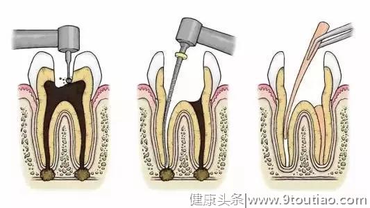 不发黑的牙齿就是健康的？实际上这种牙病已经找上你的牙齿