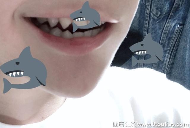 日本网友晒照片，牙齿像《火影》的干柿鬼鲛