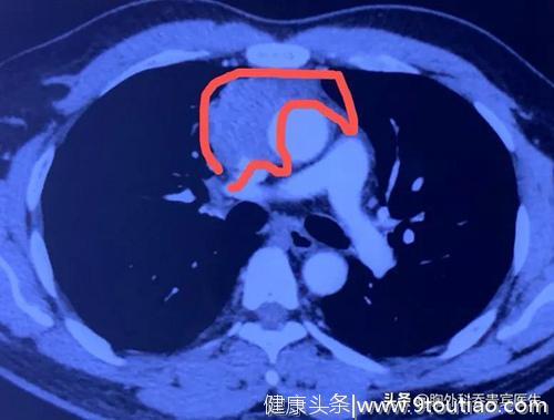 32岁男性发现前纵隔肿瘤，多学科专家努力6小时，终于切除肿物