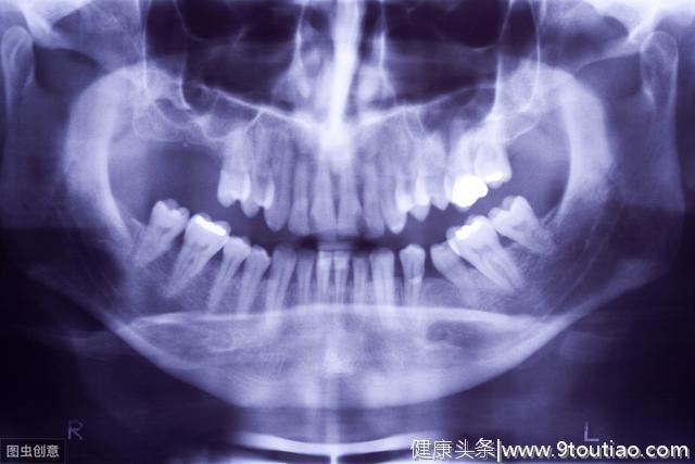 揪出残害牙周健康的杀手——牙菌斑和牙结石