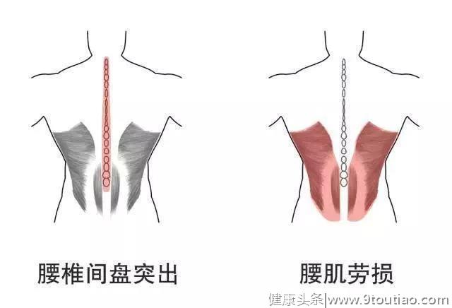 腰疼是腰椎间盘突出症还是腰肌劳损？教你3个自我鉴别的方法