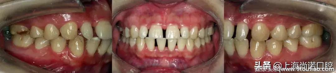 别说林允整牙作了！还不明白大牙缝有多毁颜值吗？