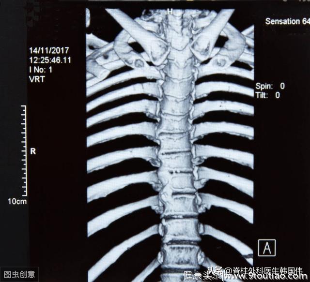 胸口和背部总是疼，到底是胸椎、颈椎还是其他方面的问题呢？