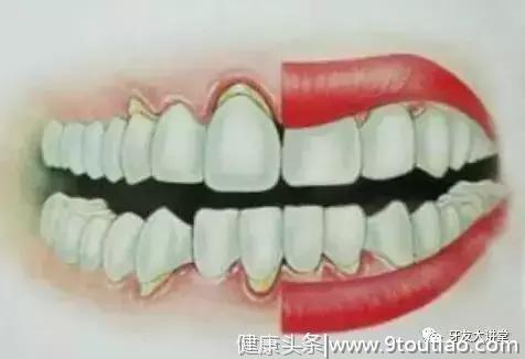 6亿国人“牙龈萎缩”预防仅占0.2%，一个举动改善你的口腔健