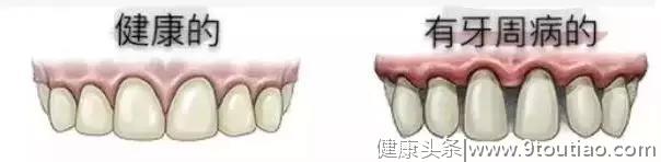 6亿国人“牙龈萎缩”预防仅占0.2%，一个举动改善你的口腔健