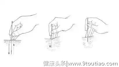 慢性疲劳综合征15个针灸治疗处方