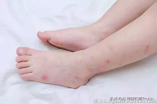 夏季这9种高发疾病，宝宝极易“躺枪”！孩子越早预防越好