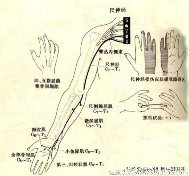 年轻女孩手指麻木几个月了，怀疑是颈椎病导致的，结果却不是