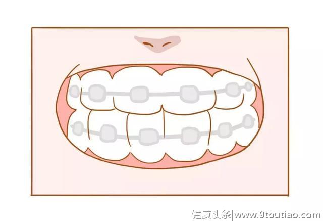 矫正牙齿有风险？把握好这6点，“换”一套健康牙，牙美人更美