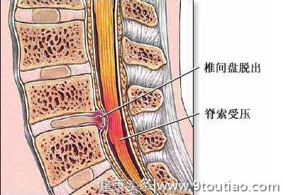 腰疼起来站都站不直？医生：3种锻炼方法让你的腰挺起来