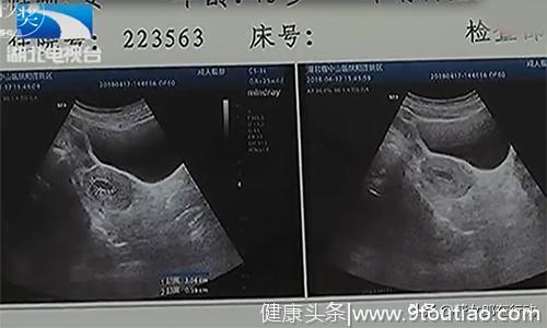 被怀孕？大姐人流手术进行中，却被告知：子宫里面什么都没有