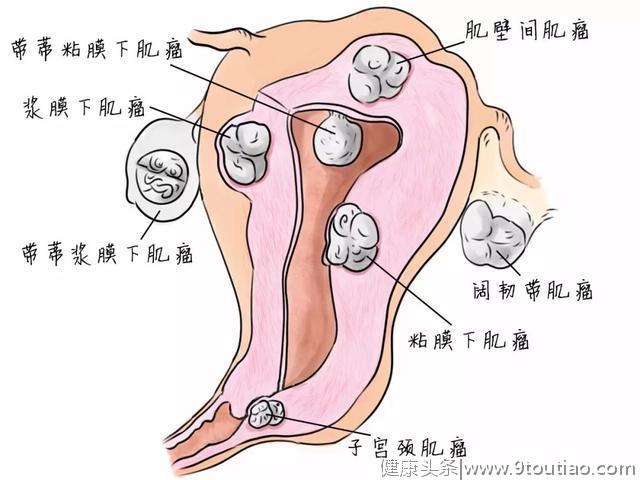 子宫肌瘤患者术后复发更难治，做好5件事，远离肌瘤再生